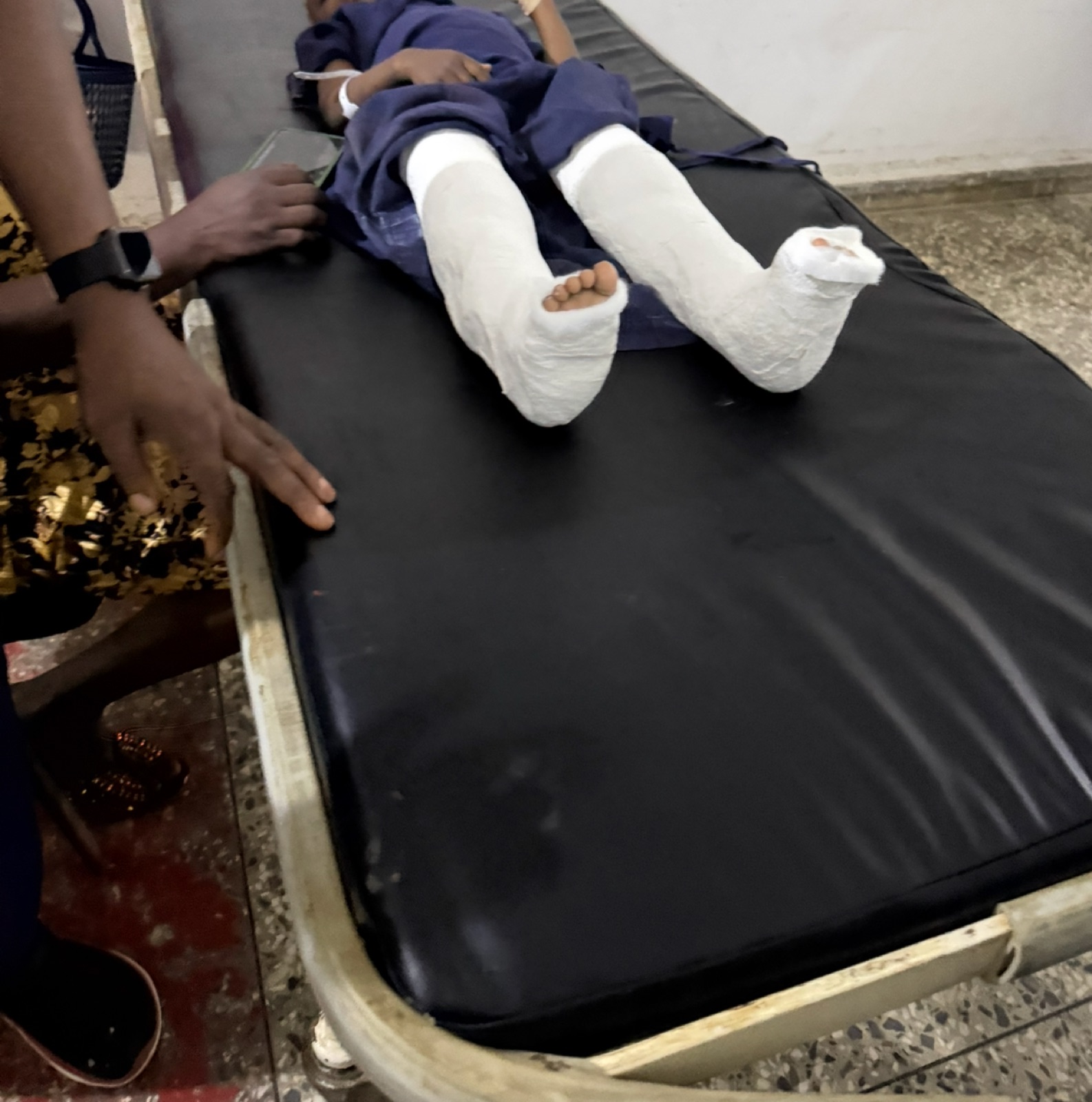 A young patient with both legs in casts after orthopedic treatment during the 2026 KBB mission